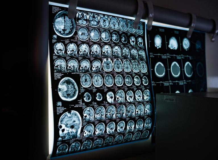A series of x-ray scans of a brain, arranged collectively on a display screen.